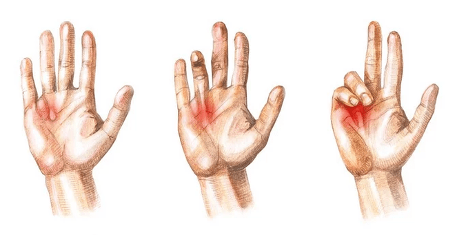 Stages of Dupuytren's contracture inability to straighten the fingers