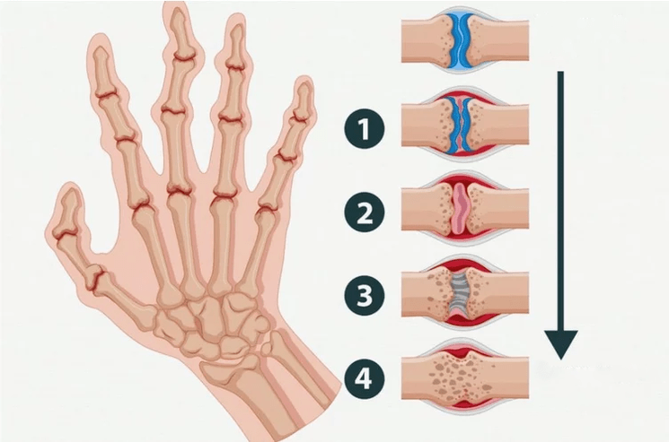 Stages of rheumatoid arthritis that affect the finger joints. 