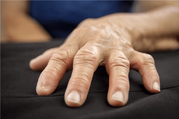 With gout, the knuckles of your fingers become hot to the touch, swollen, and painful. 