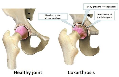 Healthy articulation affected by the articulation of cookyrosis