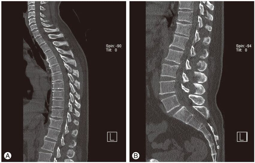 Deformation of intervertebral discs on magnetic resonance images in thoracic osteochondrosis