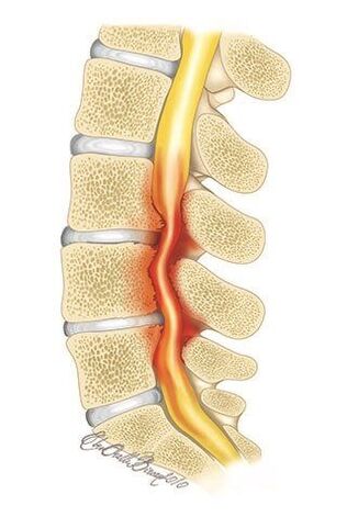With osteochondrosis of the thoracic spine, compression of the spinal canal occurs.