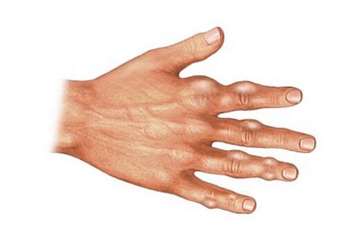 Deposition of uric acid crystals in soft tissues in gout.