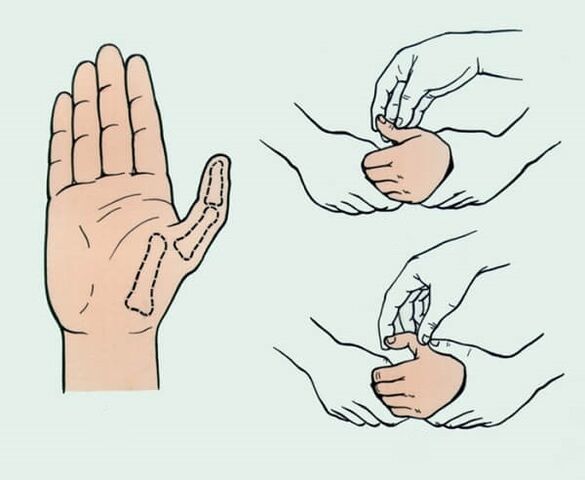 Reduction of a dislocated finger, necessary to eliminate joint pain.