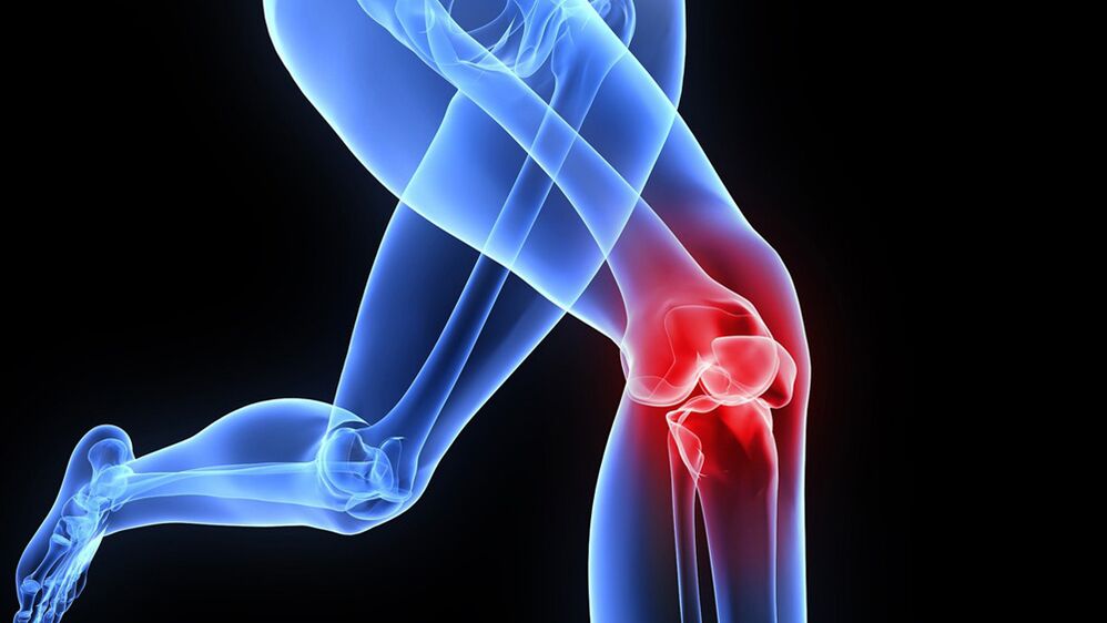 Problems with knees due to osteoarthritis.