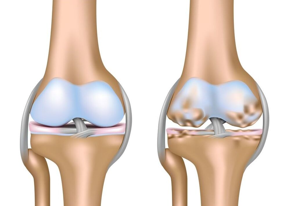 exacerbation of osteoarthritis of the joints.