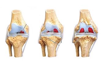 stages of development of osteoarthritis of the knee joint