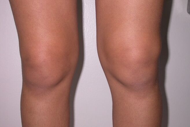 swelling of the knee joint with arthritis and osteoarthritis