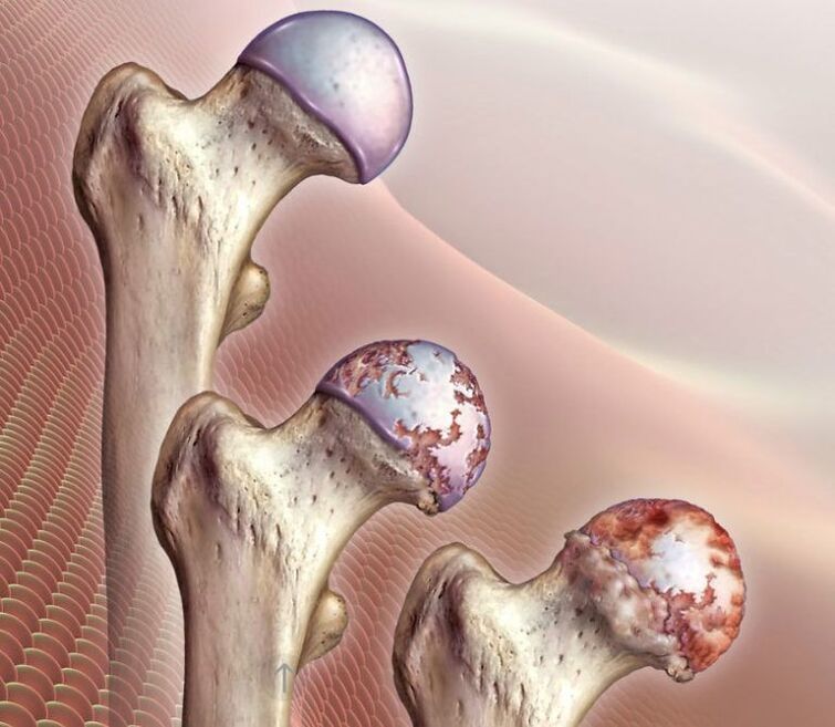 Arthrosis of the hip joint of varying degrees. 