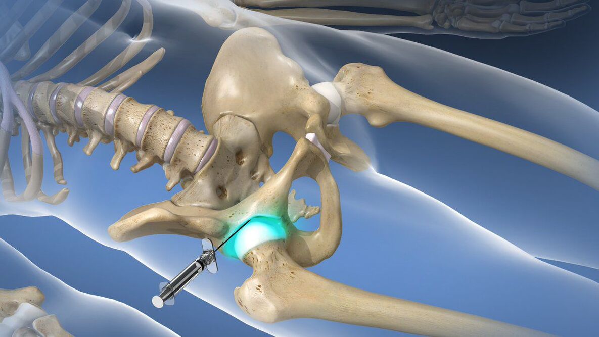 Intra-articular block for severe pain associated with hip osteoarthritis