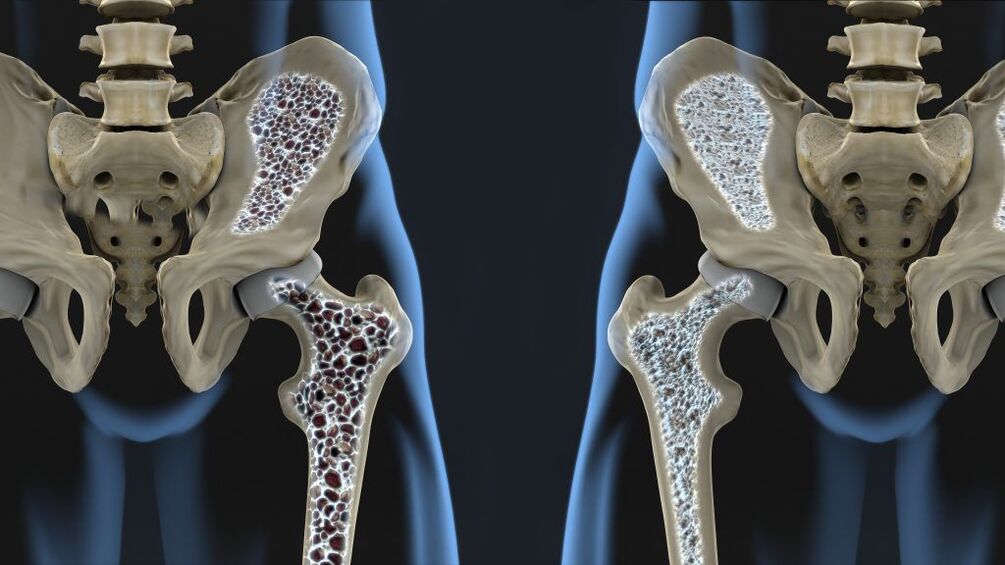 Osteoporosis is the cause of hip fracture and hip osteoarthritis. 