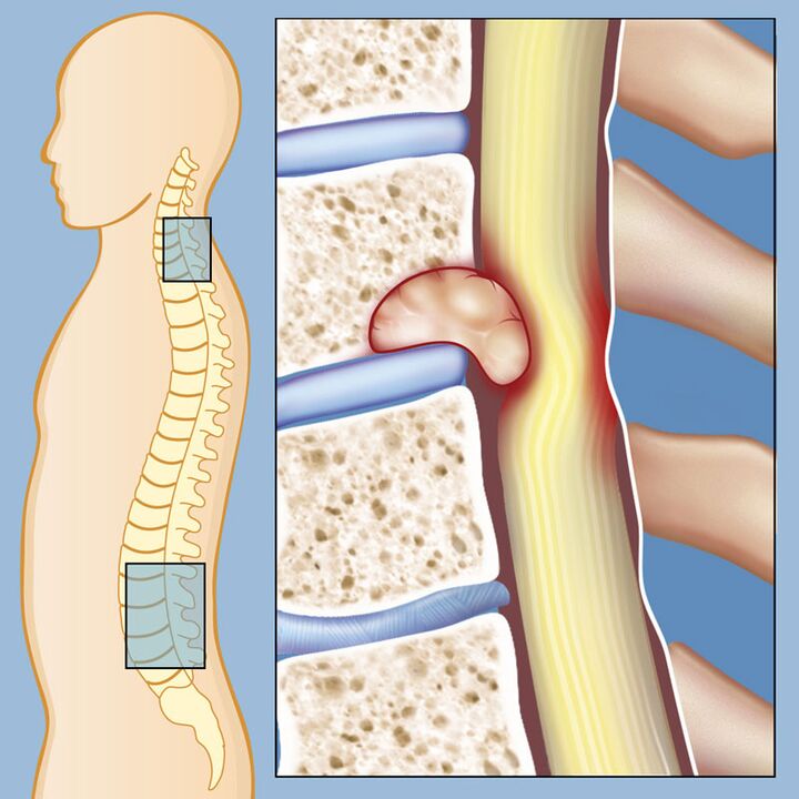 Malignant tumor as a cause of intense low back pain